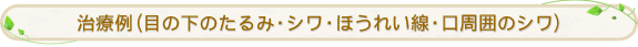 治療例(目の下のたるみ・シワ・ほうれい線・口周囲のシワ)