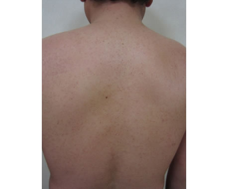 症例　背部の毛孔性苔癬（毛孔性角化症）