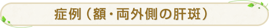 症例（額・両外側の肝斑）