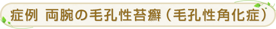 症例 両腕の毛孔性苔癬（毛孔性角化症）